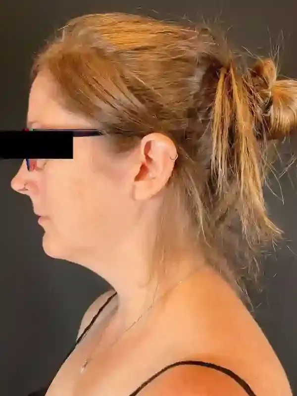 Neck Liposuction before at Après Plastic Surgery in Portland, OR