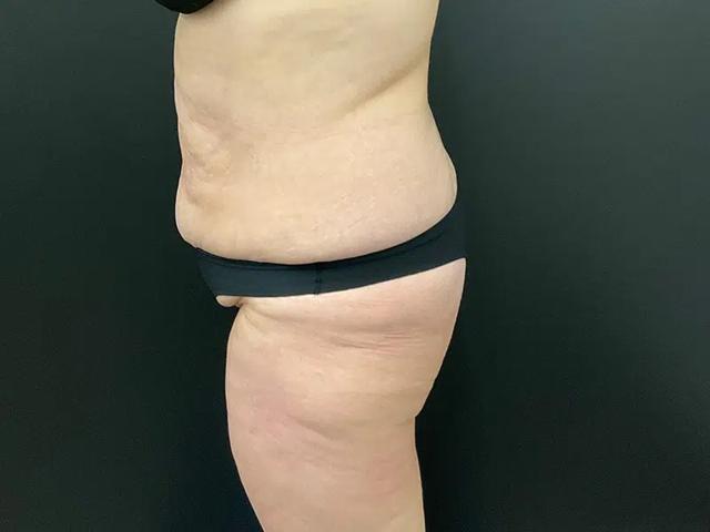 Brazilian Butt Lift before at Après Plastic Surgery in Portland, OR