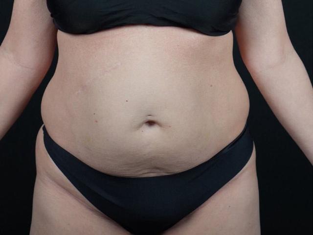 Tummy Tuck before at Après Plastic Surgery in Portland, OR