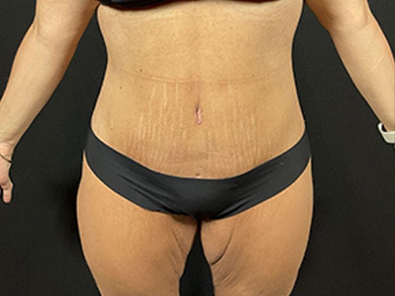 Après Plastic Surgery body lift after — Portland, OR