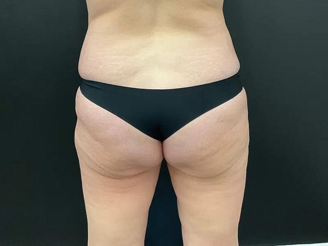 Brazilian Butt Lift before at Après Plastic Surgery in Portland, OR