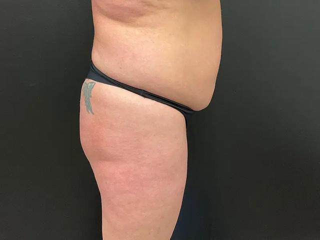Brazilian Butt Lift before at Après Plastic Surgery in Portland, OR