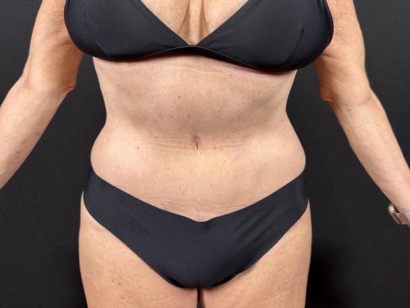 Après Plastic Surgery tummy tuck after — Portland, OR