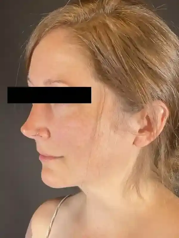 Après Plastic Surgery neck liposuction after — Portland, OR