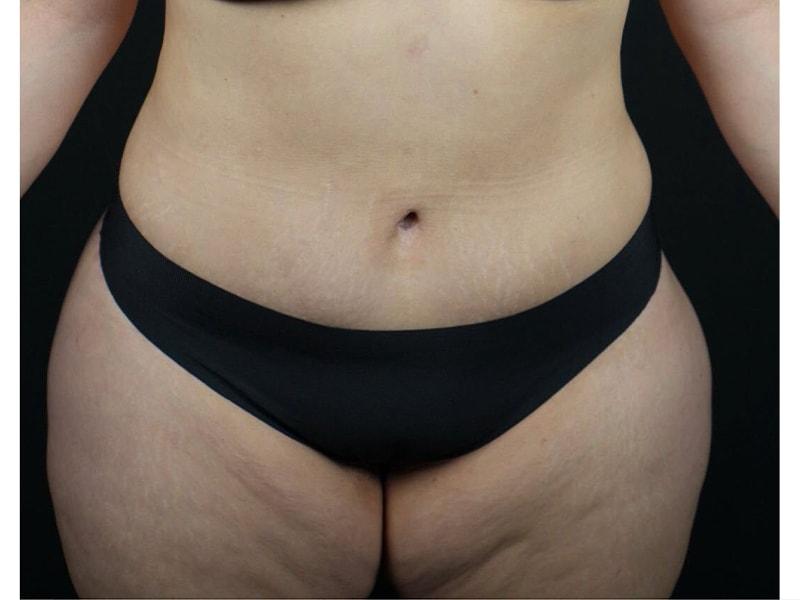 Après Plastic Surgery body lift after — Portland, OR