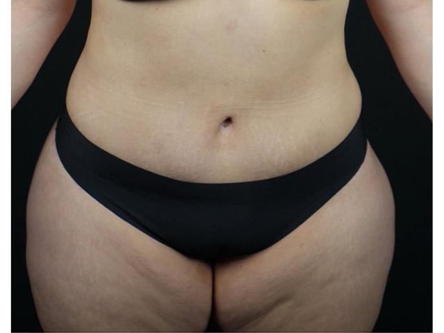 Arm Lift after at Après Plastic Surgery in Portland, OR