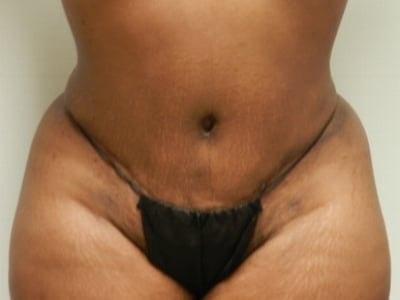 Bella Cosmetic Surgery tummy tuck after — Oxon Hill, MD