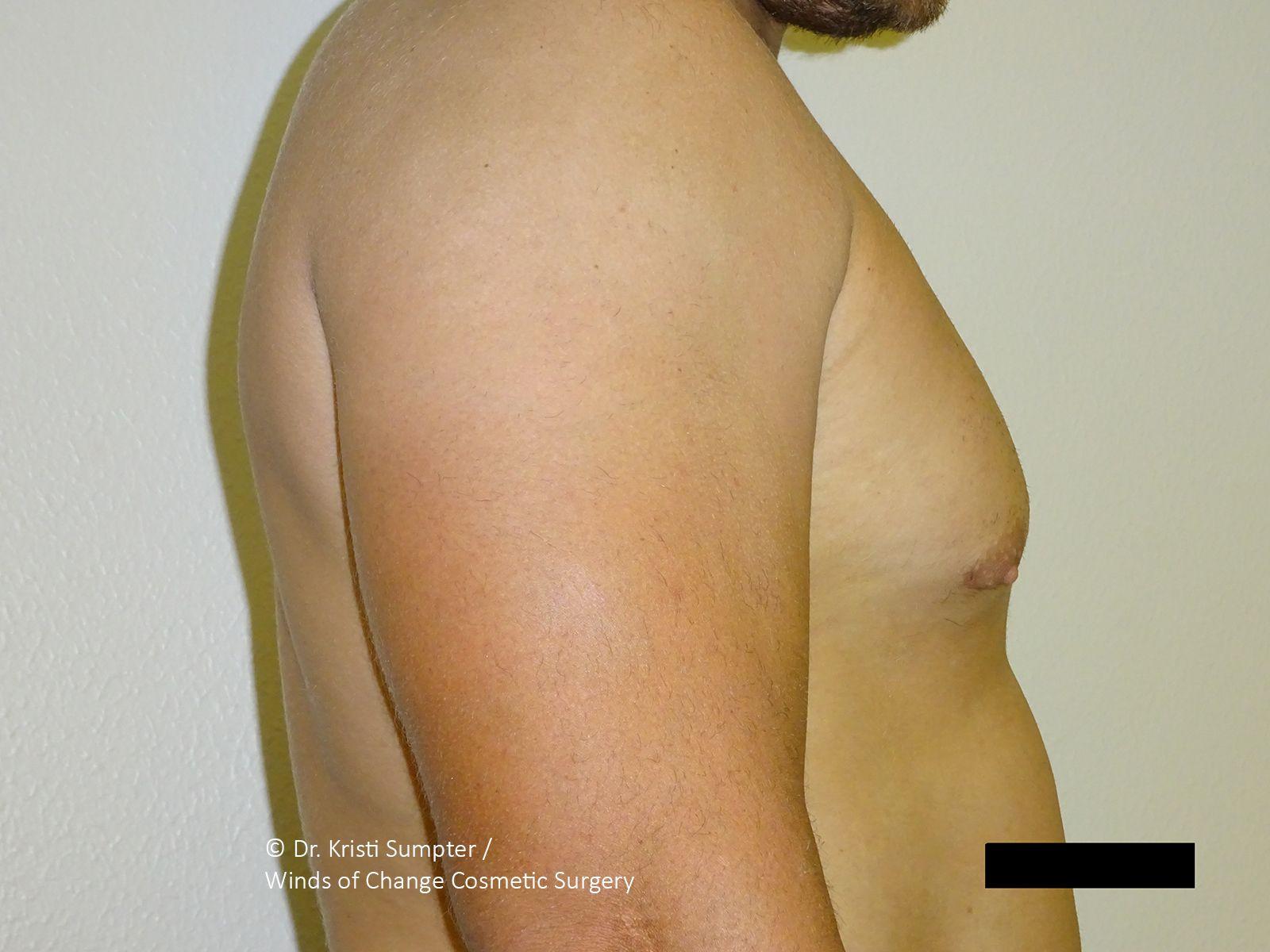 Winds of Change Cosmetic Surgery gynecomastia after — Houston, TX