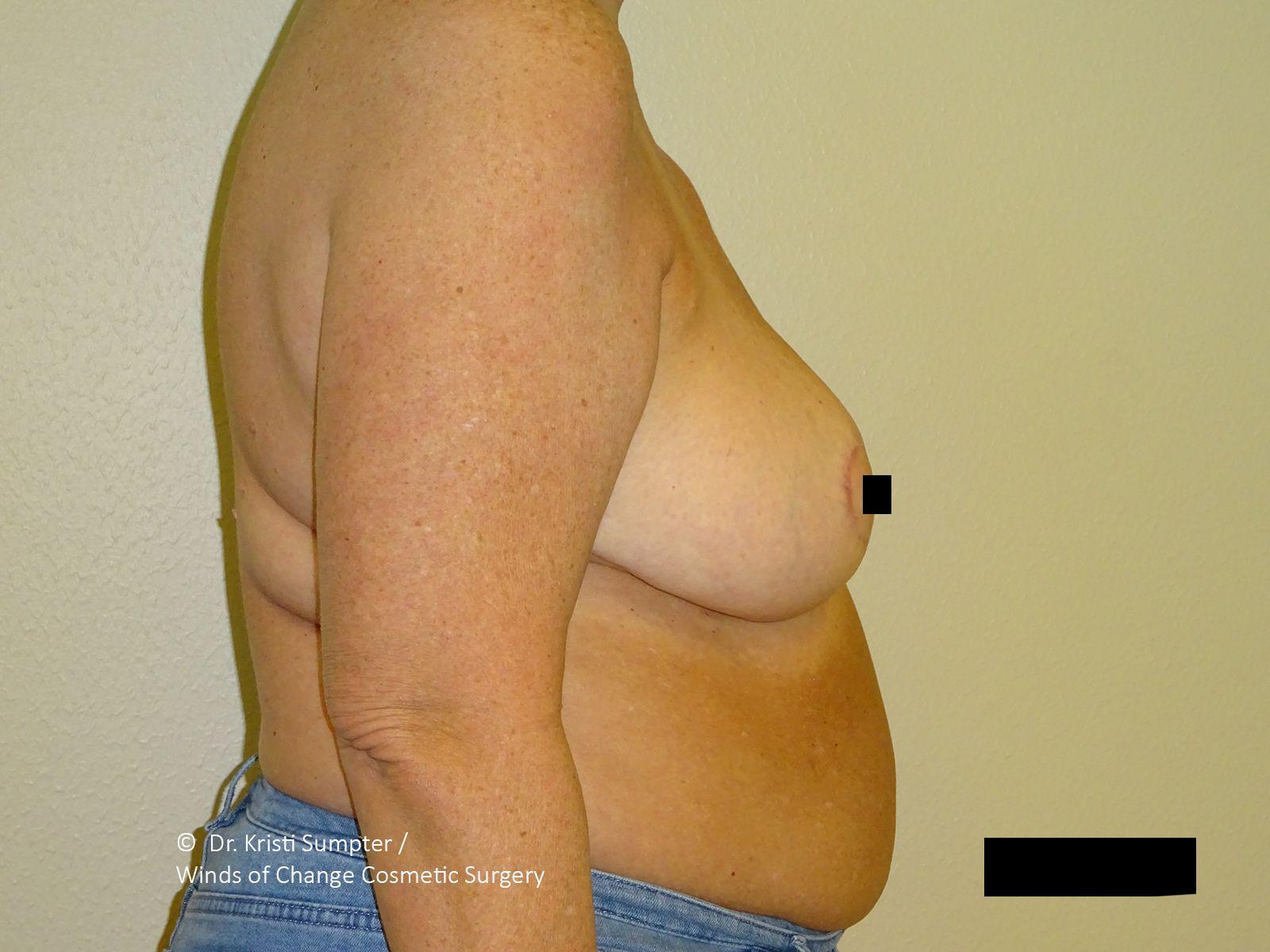 Winds of Change Cosmetic Surgery breast reduction after — Houston, TX