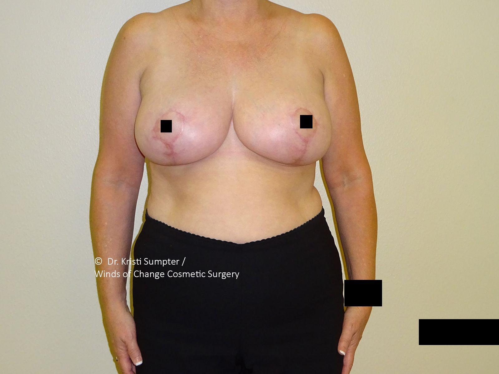 Winds of Change Cosmetic Surgery after — Houston, TX