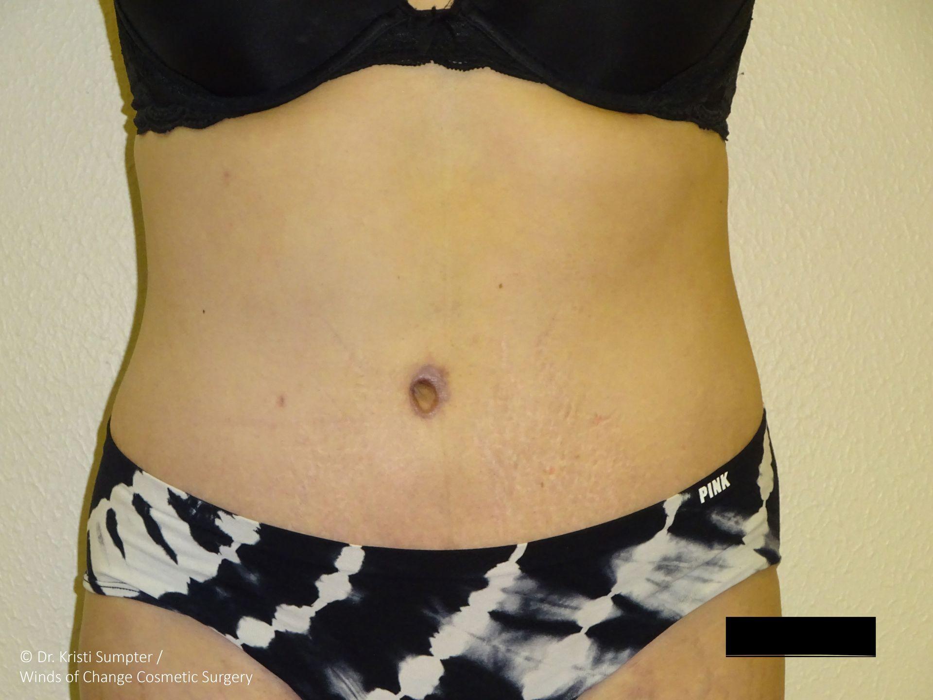 Winds of Change Cosmetic Surgery tummy tuck after — Houston, TX