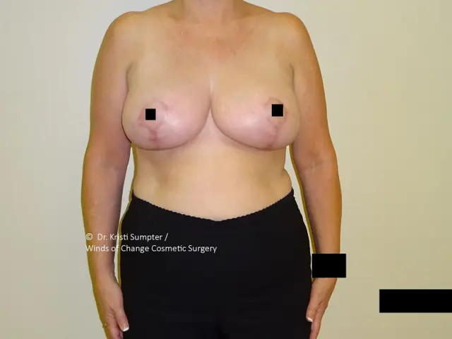 Breast Lift after at Winds of Change Cosmetic Surgery in Houston, TX