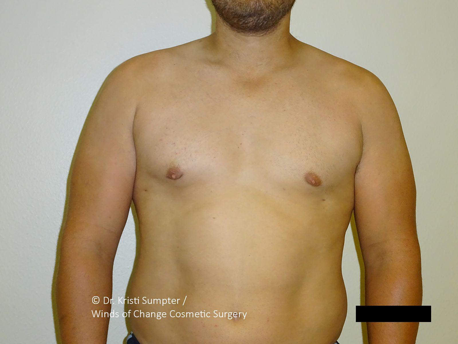 Winds of Change Cosmetic Surgery gynecomastia after — Houston, TX