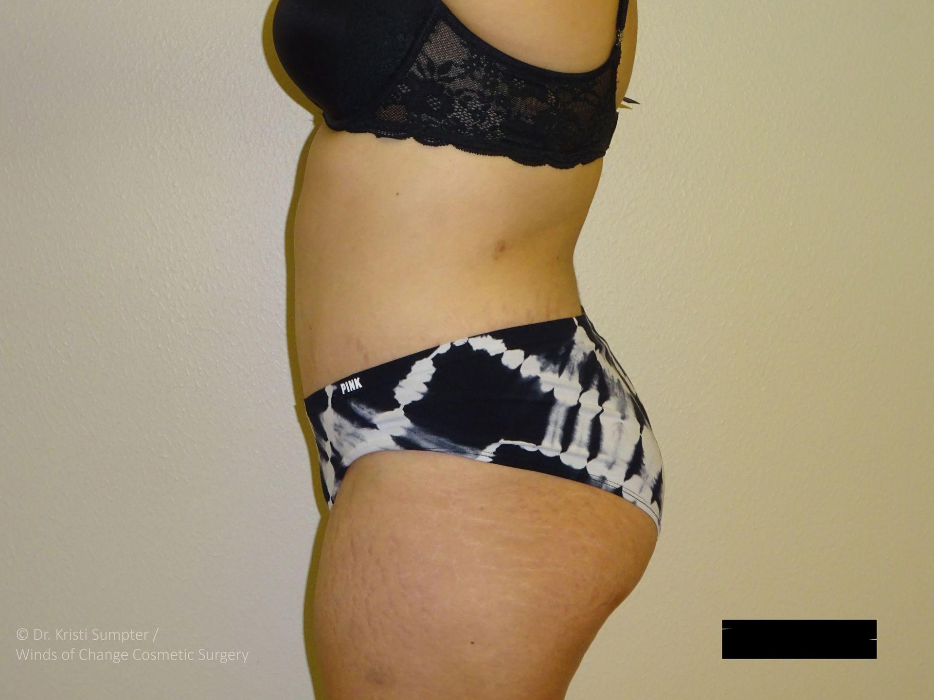Winds of Change Cosmetic Surgery tummy tuck after — Houston, TX
