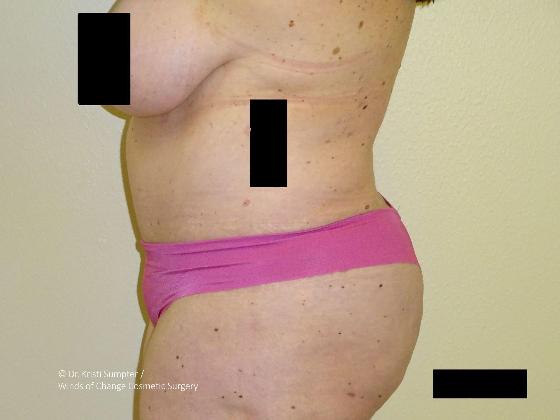 Winds of Change Cosmetic Surgery tummy tuck after — Houston, TX