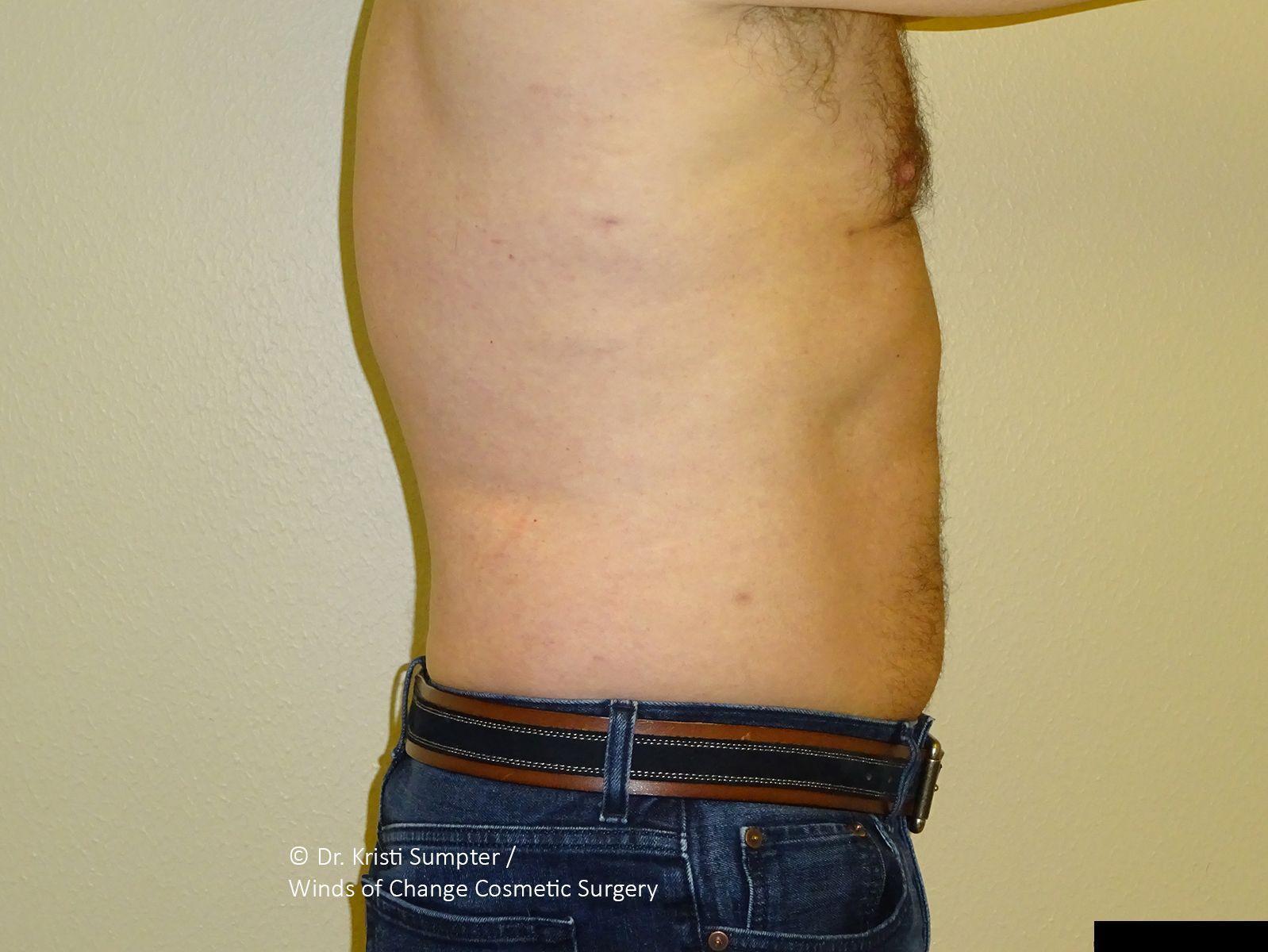 Winds of Change Cosmetic Surgery gynecomastia after — Houston, TX