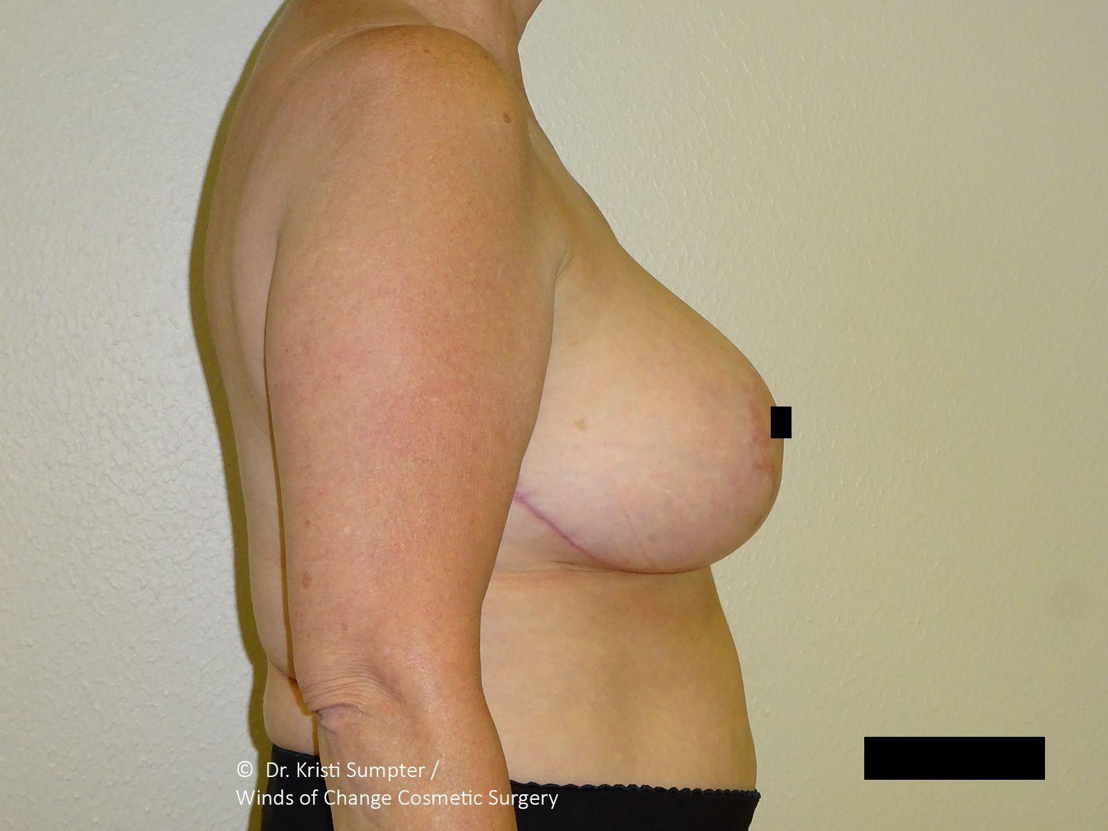 Winds of Change Cosmetic Surgery after — Houston, TX