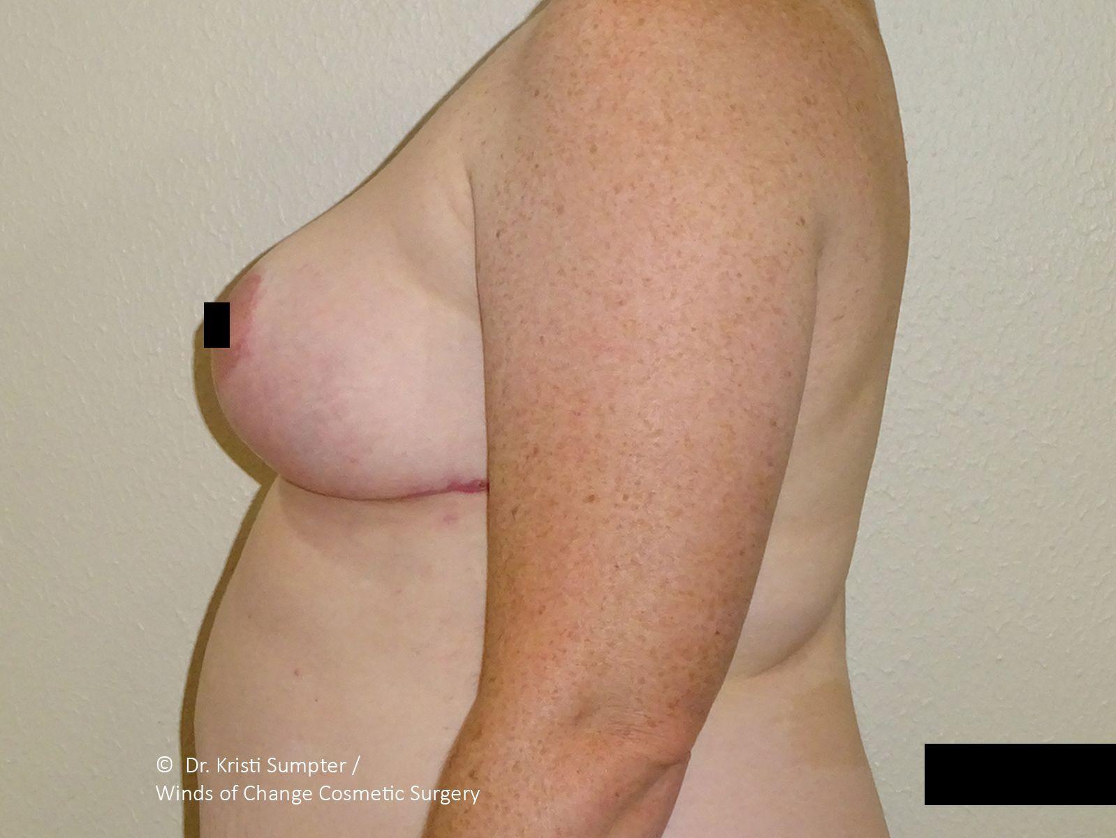 Winds of Change Cosmetic Surgery after — Houston, TX