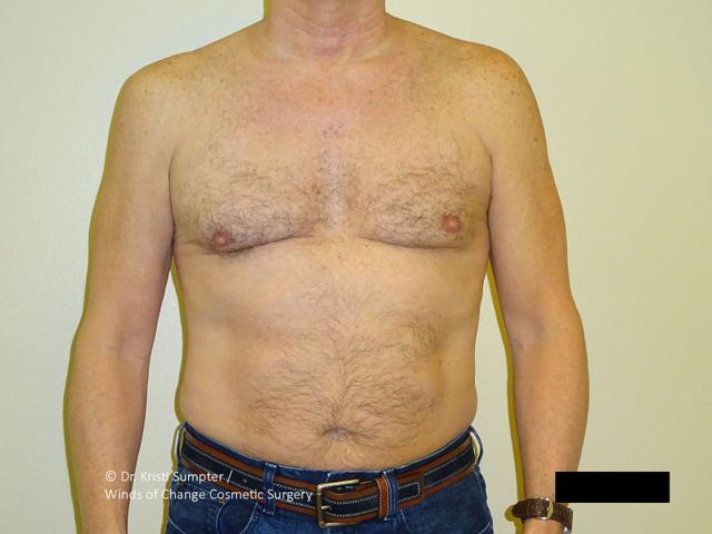 Gynecomastia Surgery after at Winds of Change Cosmetic Surgery in Houston, TX