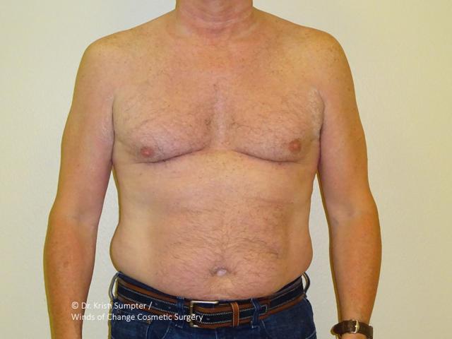 Gynecomastia Surgery before at Winds of Change Cosmetic Surgery in Houston, TX