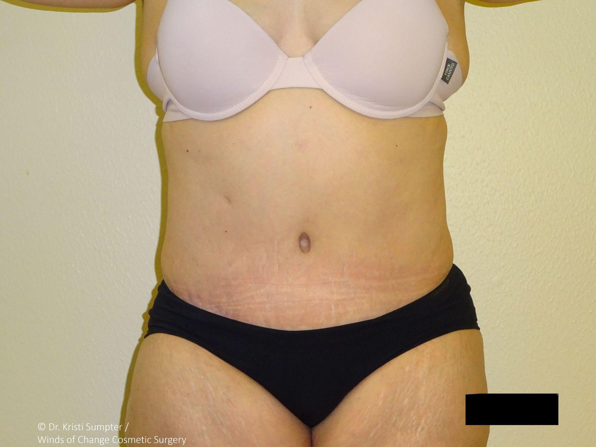 Winds of Change Cosmetic Surgery tummy tuck after — Houston, TX