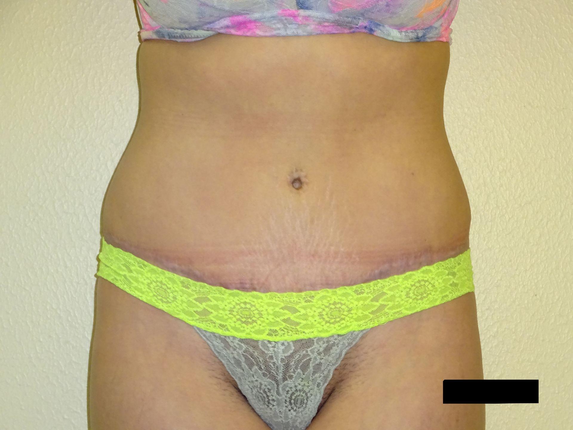 Winds of Change Cosmetic Surgery tummy tuck after — Houston, TX