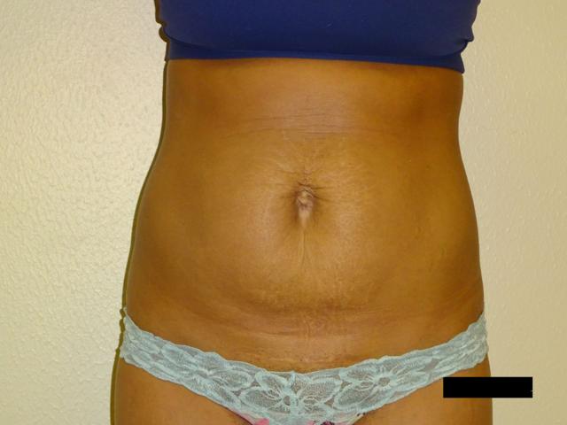 Mini Tummy Tuck before at Winds of Change Cosmetic Surgery in Houston, TX