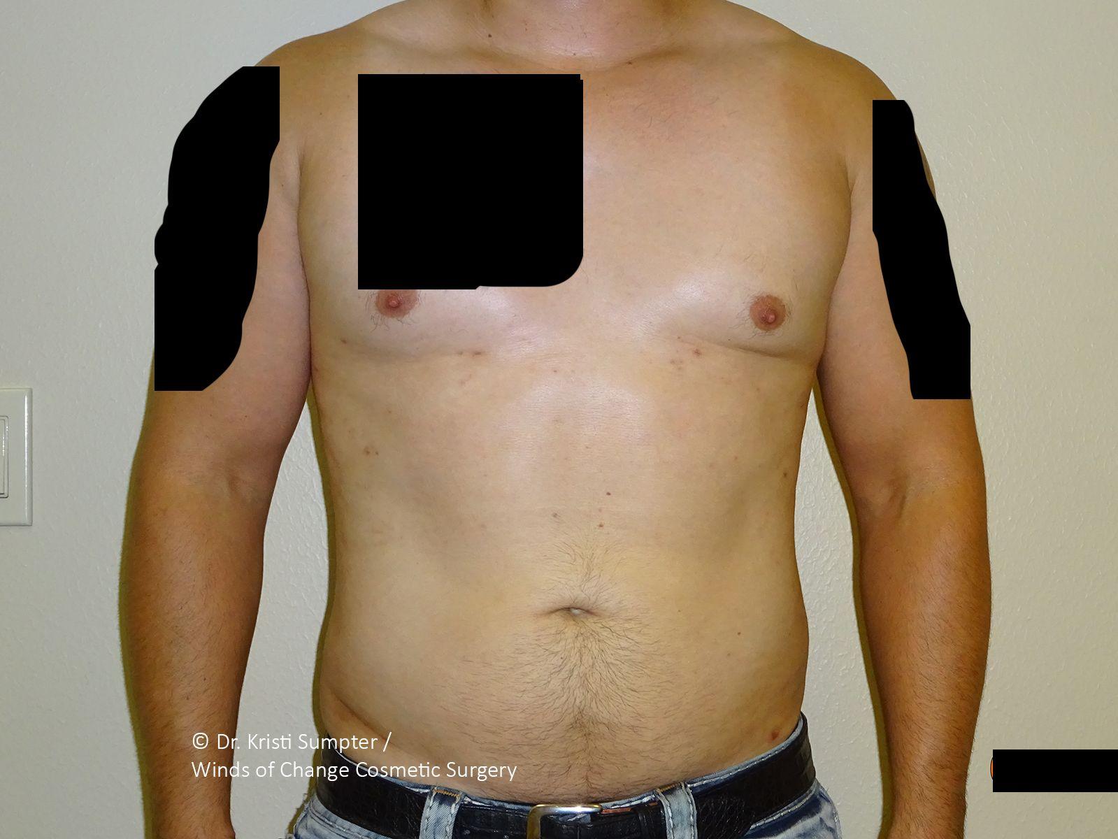 Winds of Change Cosmetic Surgery gynecomastia after — Houston, TX