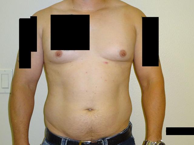 Gynecomastia Surgery before at Winds of Change Cosmetic Surgery in Houston, TX