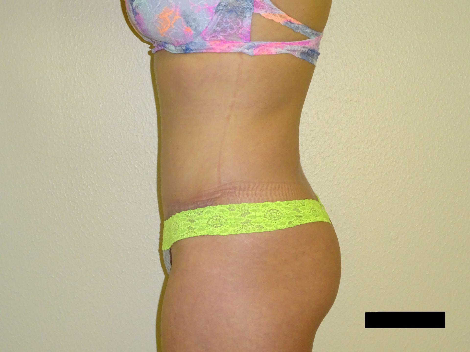 Winds of Change Cosmetic Surgery tummy tuck after — Houston, TX
