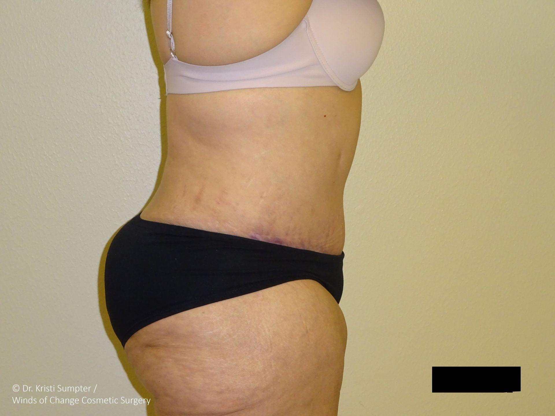 Winds of Change Cosmetic Surgery tummy tuck after — Houston, TX