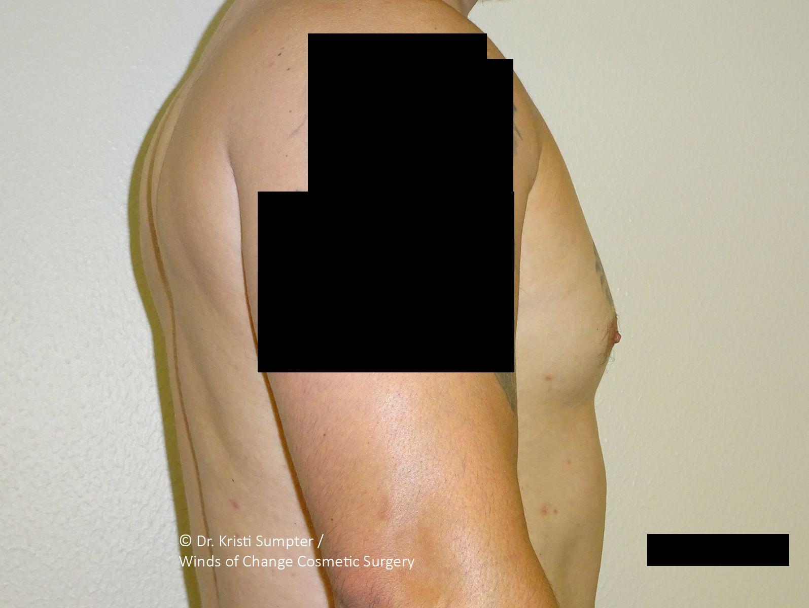Winds of Change Cosmetic Surgery gynecomastia after — Houston, TX