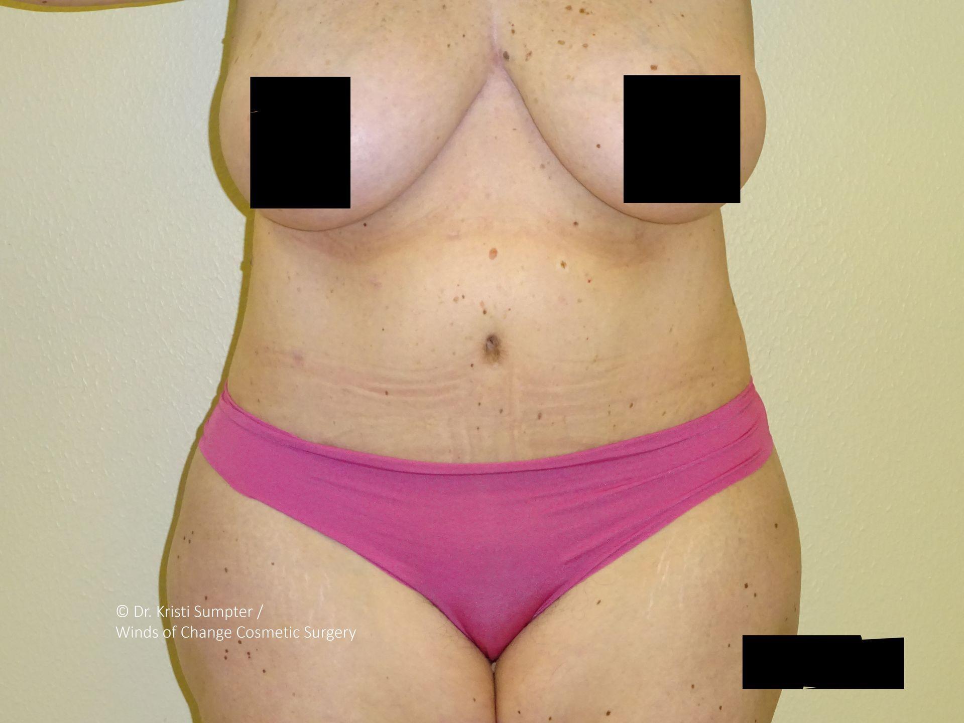 Winds of Change Cosmetic Surgery tummy tuck after — Houston, TX