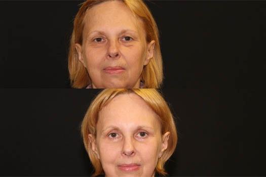 Michelle Copeland, MD, DMD brow lift result — New York, NY