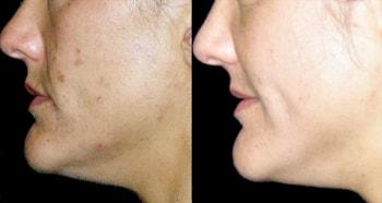 Michelle Copeland, MD, DMD laser treatment result — New York, NY