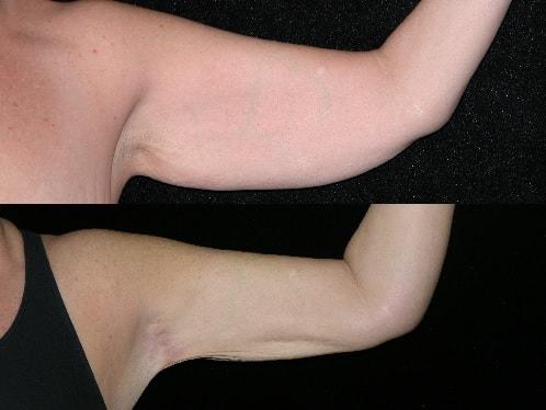 Thigh Lift result at Michelle Copeland, MD, DMD in New York, NY