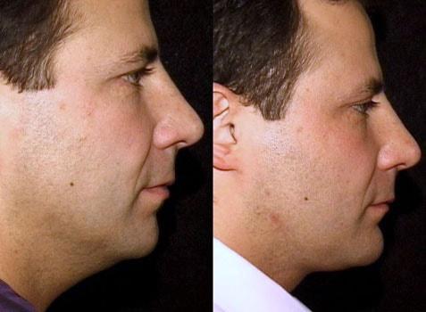Michelle Copeland, MD, DMD neck lift result — New York, NY