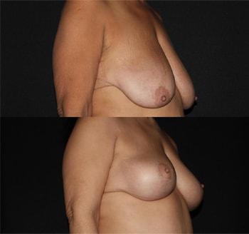 Breast Lift result at Michelle Copeland, MD, DMD in New York, NY