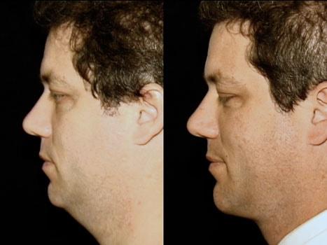 Michelle Copeland, MD, DMD neck lift result — New York, NY