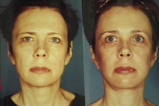Brow Lift result at Michelle Copeland, MD, DMD in New York, NY