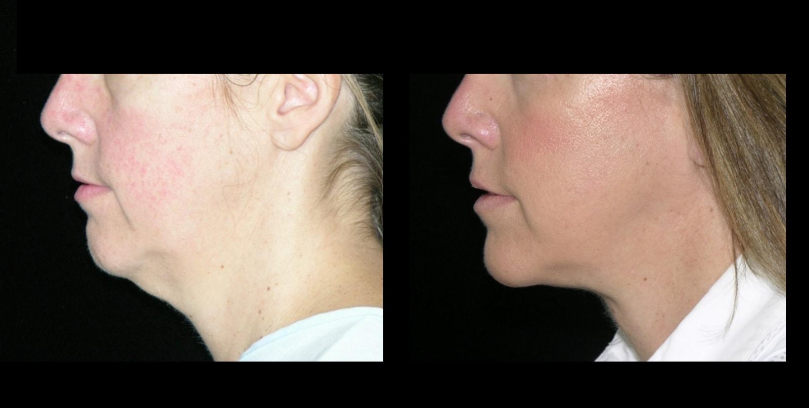 Michelle Copeland, MD, DMD neck lift result — New York, NY