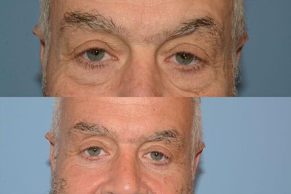 Robert A. Guida, MD laser treatment result — New York, NY