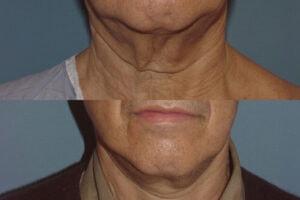 Robert A. Guida, MD facelift result — New York, NY