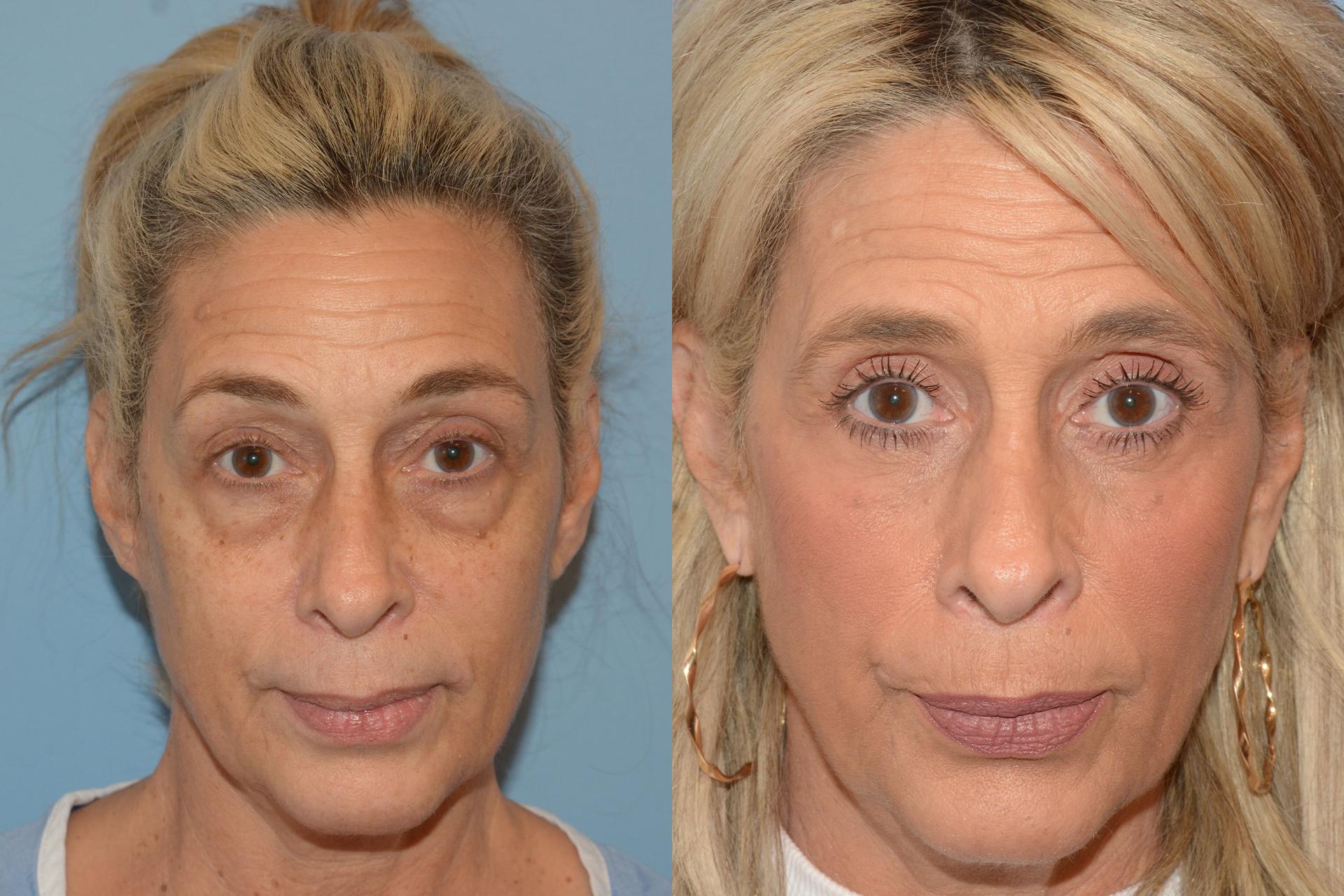 Robert A. Guida, MD laser treatment result — New York, NY