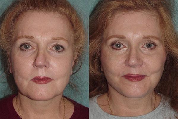 Robert A. Guida, MD facelift result — New York, NY
