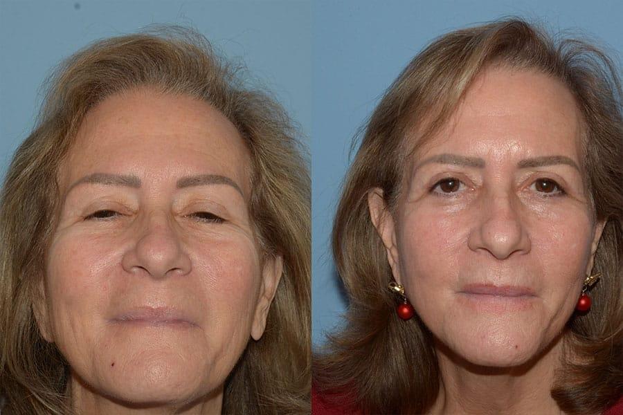 Robert A. Guida, MD laser treatment result — New York, NY