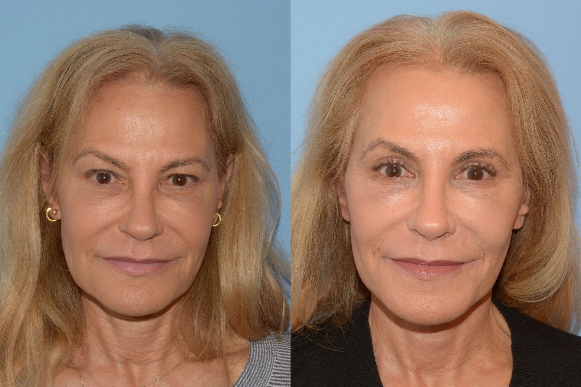Robert A. Guida, MD facelift result — New York, NY