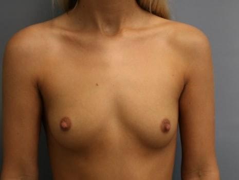 Breast Augmentation before at Orange County Cosmetic Surgery in Huntington Beach, CA