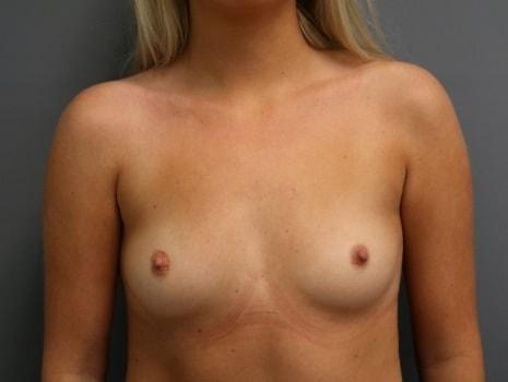Breast Augmentation before at Orange County Cosmetic Surgery in Huntington Beach, CA
