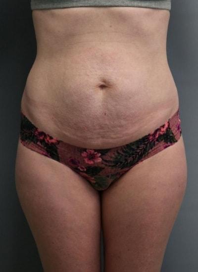 Mommy Makeover before at Orange County Cosmetic Surgery in Huntington Beach, CA